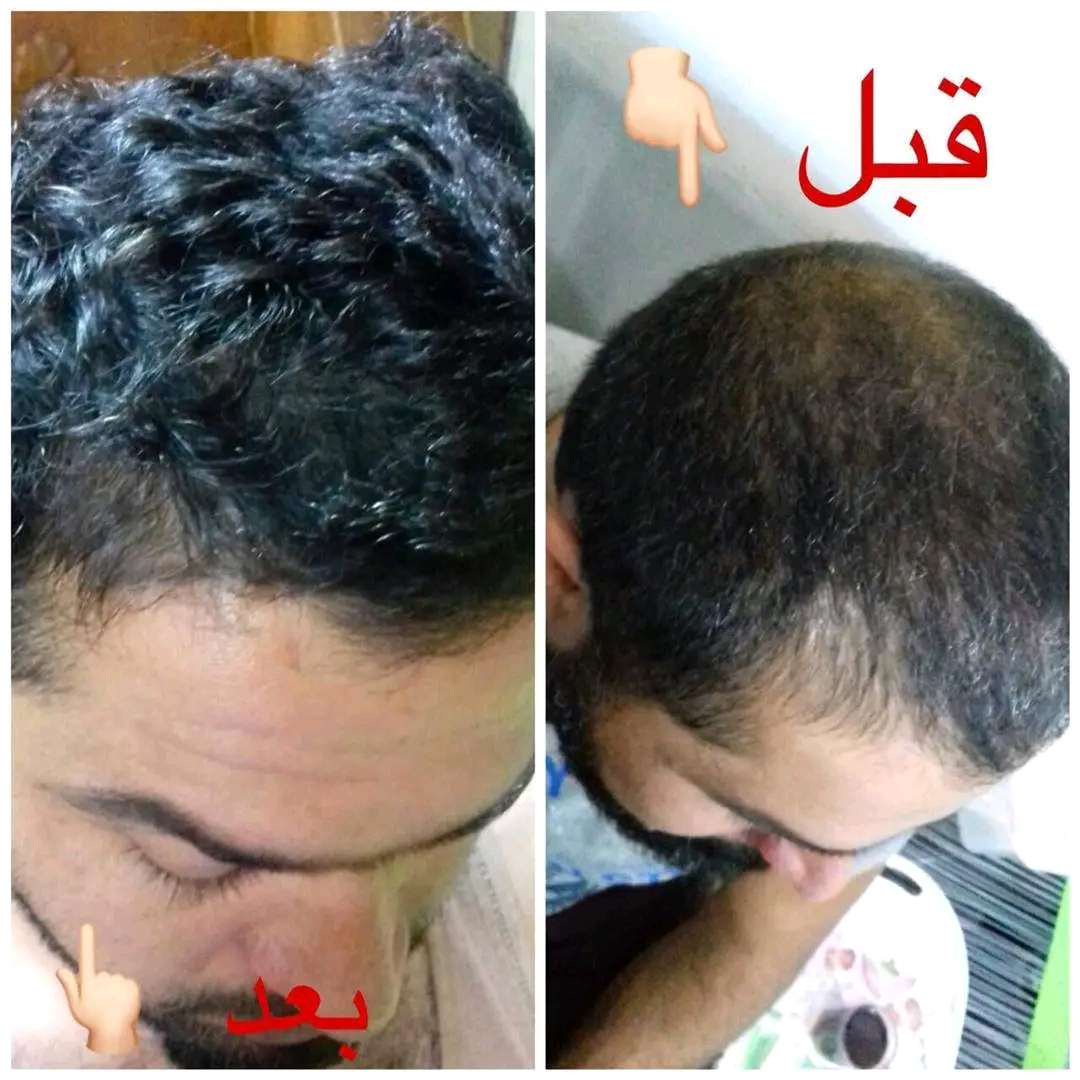 علاج الصلع والفراغات
