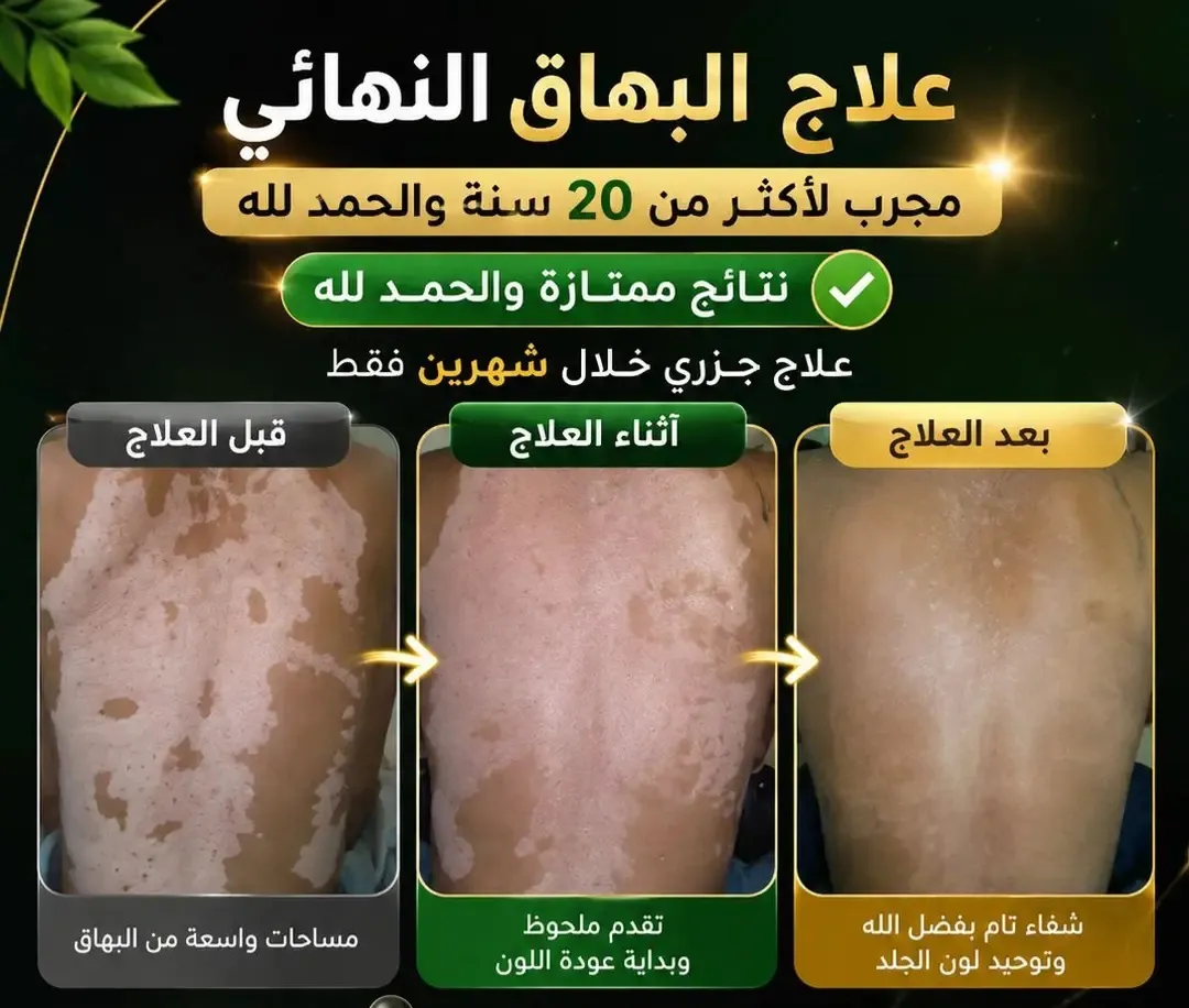 مجموعة علاج البهاق..